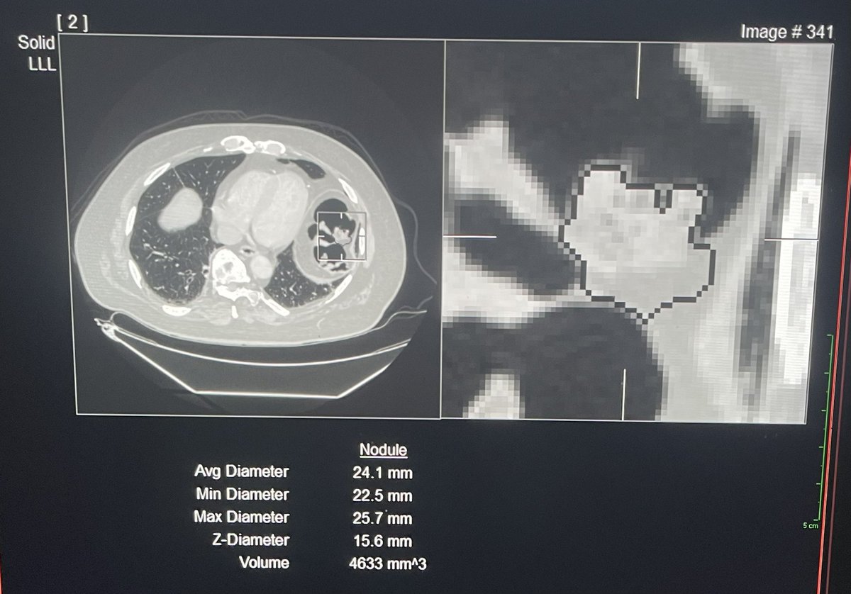 AI may replace radiologists someday, but first it needs to stop confusing stool with lung cancer