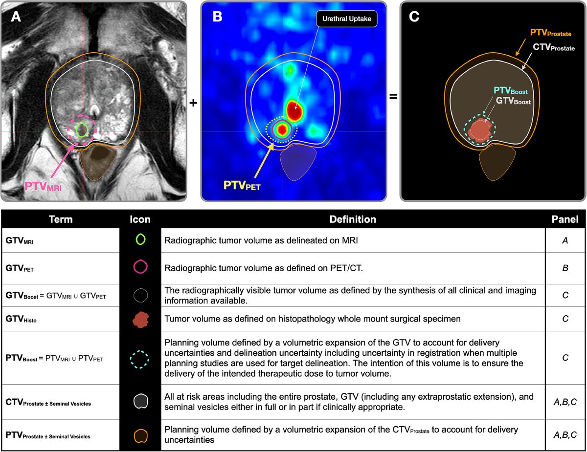 New in #practicalRO: Target Volume Optimization for Localized Prostate Cancer. #radonc tinyurl.com/propatel