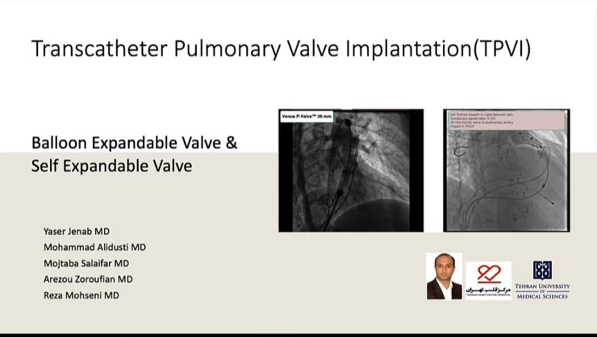 Transcatheter pulmonary valve implantation (TPVI): Balloon expandable valve (Myval) versus self expandable valve (P valve)
youtu.be/8zTXHHwR1XE?si…