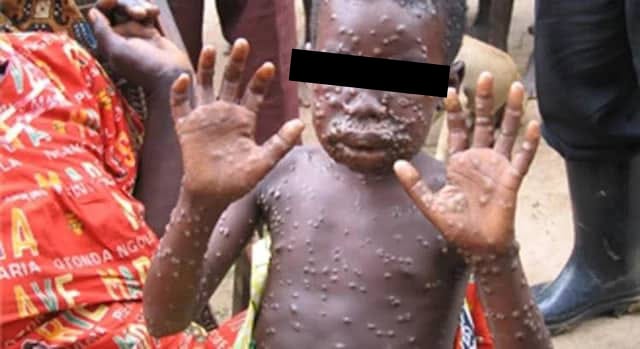🦠 #Varioledusinge à #Kinshasa : 212 cas suspects, 31 cas confirmés et 2 décès. 11 zones de santé touchées. L'#OMS a déclaré l'épidémie #Mpox comme urgence sanitaire internationale. Restez informés et suivez les recommandations sanitaires. Plus d'infos sur infos27.cd