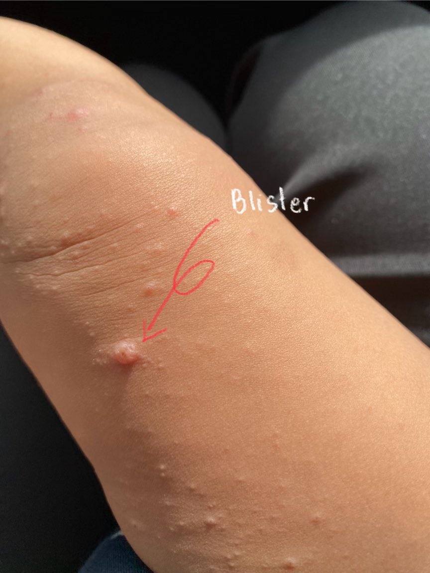 MaisarahMahmud's tweet photo. Last week, my son was contacted with HFMD virus.

Doctor cakap musim dia datang balik. Ada one of my followers from Instagram, dia share guna Sabun Himalaya ni. Bagus sangat, cepat je blisters tu pecah and tinggal kuping.

I would recommend lah to buy. Beli di Alpro Pharmacy 🤩 https://t.co/QEdhEvqIST