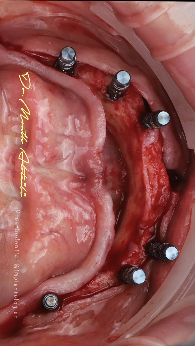 تم تعويض المراجع ب ٦ زرعات للفك السفلي خلال جلسة واحده
نتيجة فقدانه للاسنان

#زراعة_الاسنان