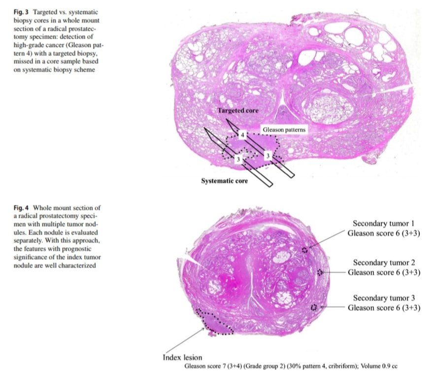 Dra. María Natalia Gandur Quiroga (@nataliagandur) on Twitter photo 💫🌟🔬 Gleason system evolution: Fundamental for accurate prostate cancer diagnosis and prognosis🌟
<a href="/AlessiaCim/">Alessia Cimadamore</a> <a href="/LiangChengMD/">Liang Cheng, MD</a> Antonio Lopez-Beltran Carmine Franzese <a href="/GGiannarini/">Gianluca Giannarini</a> <a href="/AlessandroCres/">Alessandro Crestani</a> Eamonn T. Rogers Rodolfo Montironi
📊 Grade Groups (GGs): Developed from Gleason 💫🌟🔬 Gleason system evolution: Fundamental for accurate prostate cancer diagnosis and prognosis🌟
<a href="/AlessiaCim/">Alessia Cimadamore</a> <a href="/LiangChengMD/">Liang Cheng, MD</a> Antonio Lopez-Beltran Carmine Franzese <a href="/GGiannarini/">Gianluca Giannarini</a> <a href="/AlessandroCres/">Alessandro Crestani</a> Eamonn T. Rogers Rodolfo Montironi
📊 Grade Groups (GGs): Developed from Gleason