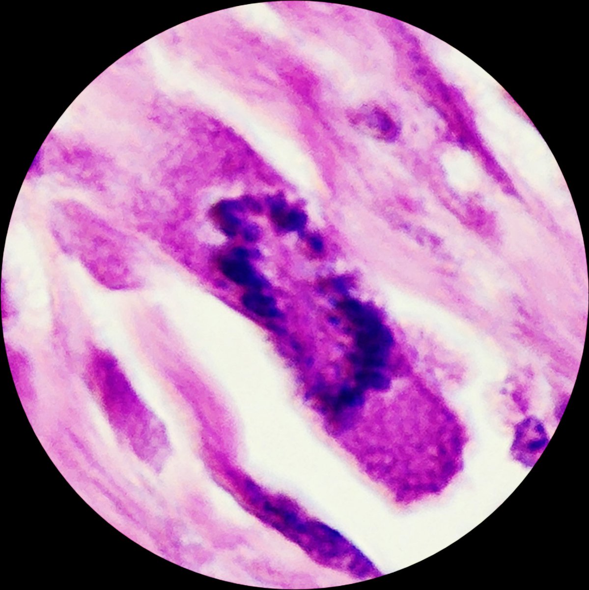 SyedSal55391459's tweet photo. #histopathology
#neoplasm
#pathX
#mitosis
#photomicrograph 
Atypical mitotic figure. https://t.co/oHpjXzy0Dh