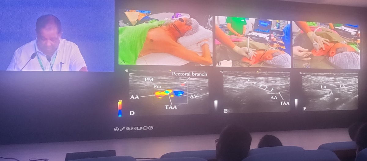 VARUN SINGLA MD PDCC (@drpainphysician) on Twitter photo Prof manoj Karmakar spilling the secrets to spine usg for epidural. <a href="/AoraIndia/">AORA India</a> <a href="/RAPMOnline/">Regional Anesthesia & Pain Medicine</a> <a href="/ESRA_Society/">ESRA | European Society of Regional Anaesthesia</a> <a href="/ASRA_Society/">ASRA Pain Medicine</a> <a href="/RegionalAnaesUK/">RA-UK</a> <a href="/CAS_RegAnes/">CAS Regional & Acute Pain Section</a> <a href="/BelgianBara/">Belgian Association of Regional Anesthesia BARA</a> <a href="/BucksUSGRA/">BucksUSGRA</a> Prof manoj Karmakar spilling the secrets to spine usg for epidural. <a href="/AoraIndia/">AORA India</a> <a href="/RAPMOnline/">Regional Anesthesia & Pain Medicine</a> <a href="/ESRA_Society/">ESRA | European Society of Regional Anaesthesia</a> <a href="/ASRA_Society/">ASRA Pain Medicine</a> <a href="/RegionalAnaesUK/">RA-UK</a> <a href="/CAS_RegAnes/">CAS Regional & Acute Pain Section</a> <a href="/BelgianBara/">Belgian Association of Regional Anesthesia BARA</a> <a href="/BucksUSGRA/">BucksUSGRA</a>