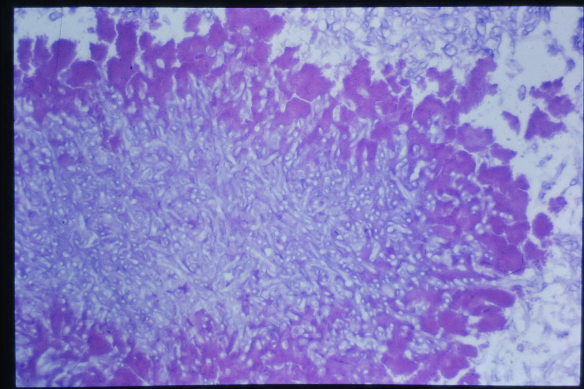 smlungpathguy's tweet image. Aspergillus surrounded by Splendore-Hoeppli phenomenon (derbis + antigen/antibody complexes) #pathbugs

Image courtesy: @yro854 #yalerosenslidecollecton

Super interesting back story on Reinhard Hoeppli:
nybooks.com/articles/1977/…