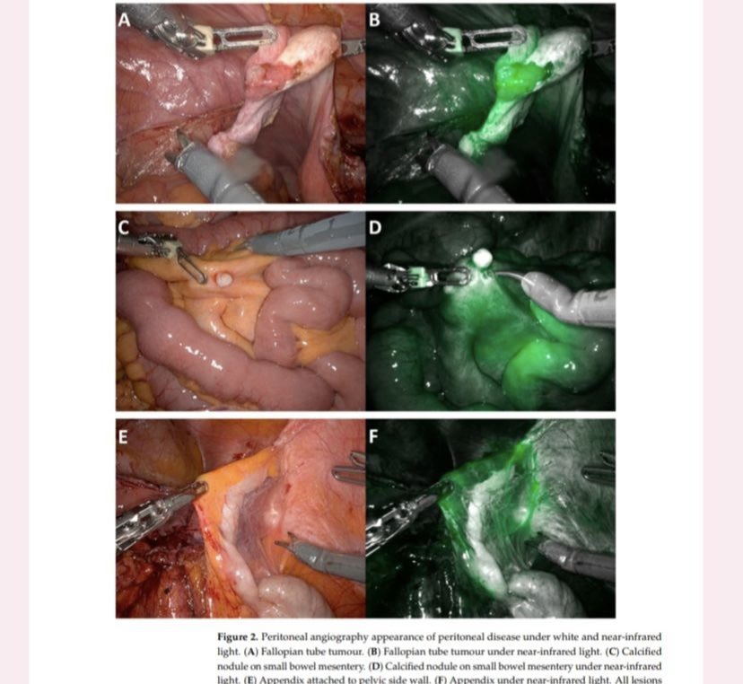 New publication on #MIRRORS study by our vice-president  @christina.uwins !!!
#roboticsurgery#mirrors#ovariancancer#sergs#years.network