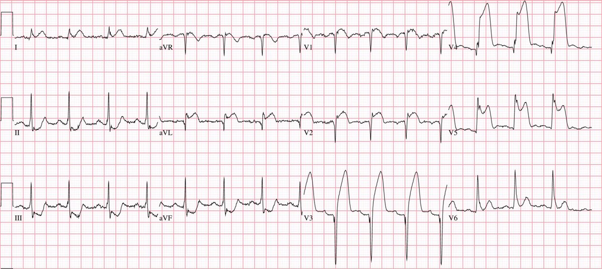 Farmers be like: “I would’ve come in sooner but I didn’t wanna bother you guys.”

Their ECG: