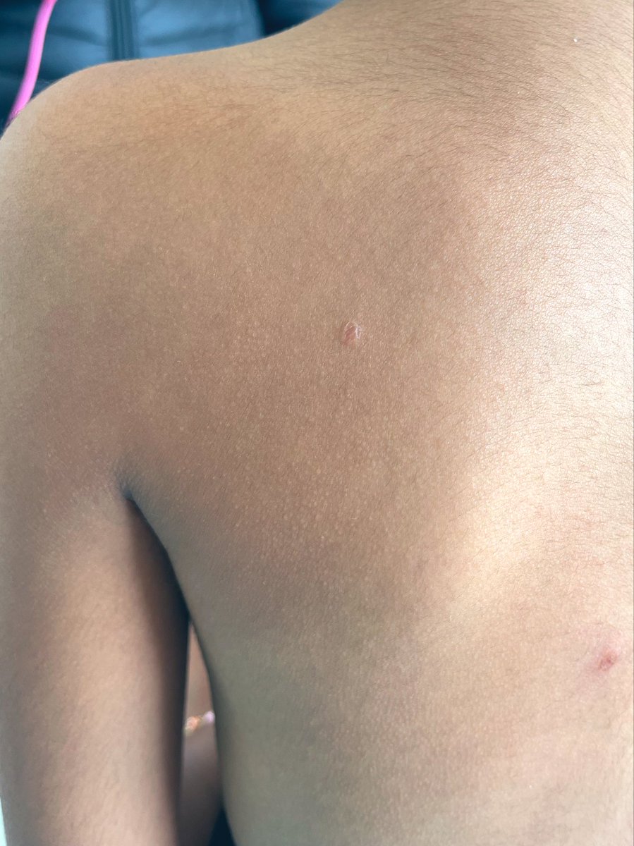 Colegas Dermas !! Quiero compartirles un caso que acabo de ver en la consulta y que no tengo diagnóstico, y muchas dudas. Ojalá nos puedan dar luz voy a mostrar solo una foto.  7 años, 2 semanas de evolución, inicialmente pruriginosas y posteriormente ardorosas