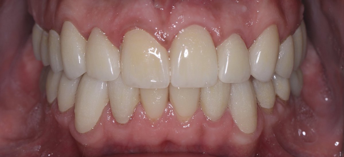 From this to this 🦷