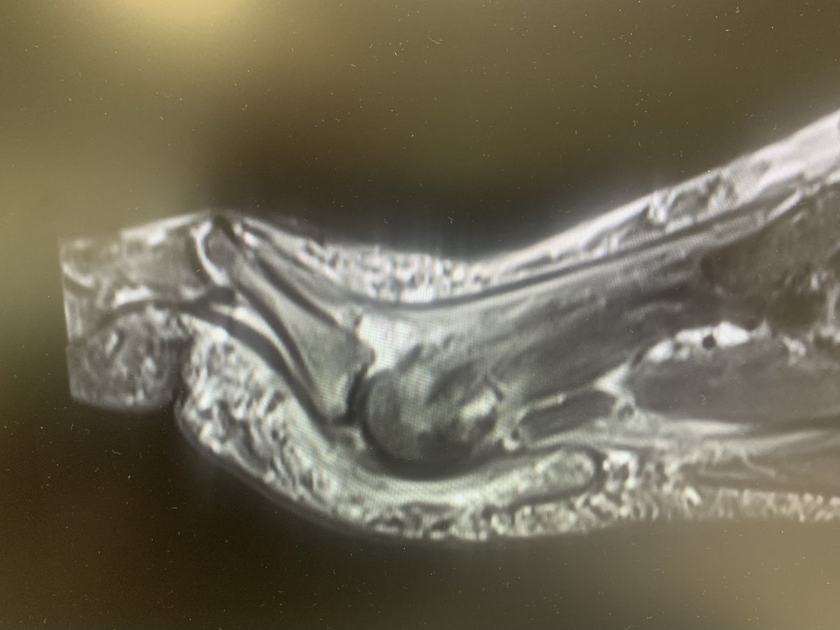 MgJenrique's tweet photo. Paciente 54 años metatarsalgia muy severa M2-distal. Sensación de calambres. 2º dedo elevado. Signo del cajón positivo con subluxación MTF. Fue  Dx de N Morton 2º espacio ?? (Falso). Se trata de un caso típico de rotura de la placa plantar. Aporto imágenes de RMN. https://t.co/HMyhhGZV5G