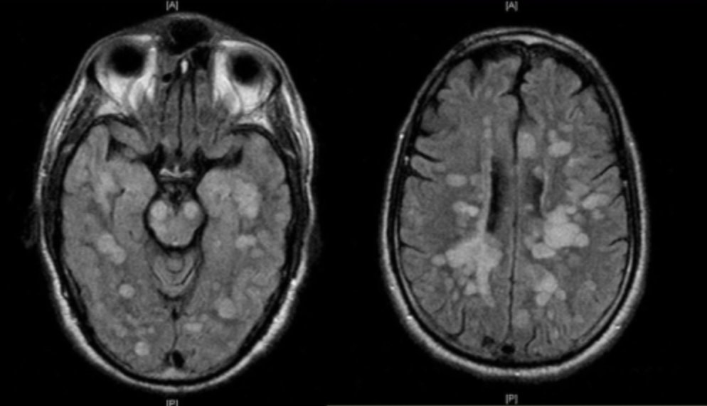 NeuroWalid's tweet photo. MRI of 6 years old boy with lethargy and altered mentation. Recent MMR vaccine which triggered ADEM disease. Treated with IV methylprednisolone for 5 days then 2 weeks PO taper . Rare: 0.3-0.6 in 100,000.
2nd line: plasmapheresis, IVIG
3rd line: Rituximab
#neurocase #neurotip https://t.co/pT4Ou4lBs1