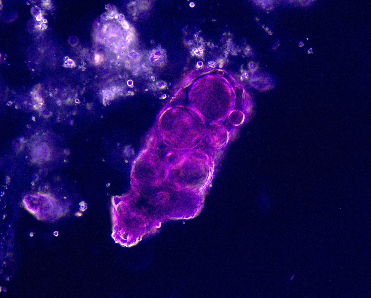 Juan Carlos Q Velez (@veleznephhepato) on Twitter photo Vacuolar cast in a #UrinarySediment from a pt with endocarditis-associated glomerulonephritis and nephrotic-range proteinuria. Dark field illumination, SM stain. #UrineMicroscopy <a href="/OchsnerNephro/">Ochsner Nephrology</a> pdfs.journals.lww.com/kidney360/2024… Vacuolar cast in a #UrinarySediment from a pt with endocarditis-associated glomerulonephritis and nephrotic-range proteinuria. Dark field illumination, SM stain. #UrineMicroscopy <a href="/OchsnerNephro/">Ochsner Nephrology</a> pdfs.journals.lww.com/kidney360/2024…