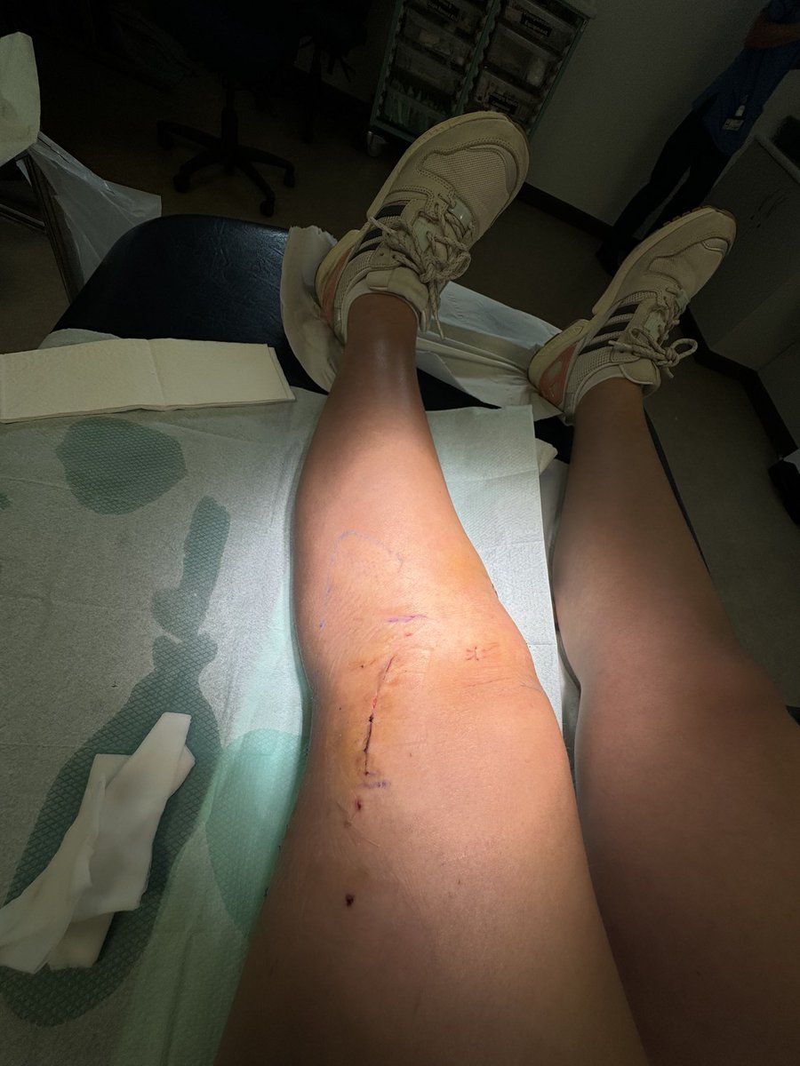 Z1000blue's tweet photo. When your surgeon is one of the best in the world this is the result of ACL &amp; IT band repair now on to rehab https://t.co/N9eD4pvuhT