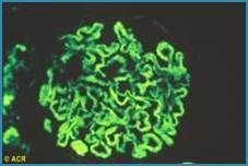 Systematic review of anti-Sm Abs (17 studies) shows Sm Abs to have 90% specificity for SLE. Although Smith Abs assoc w/ higher SLE activity, they are not predictive of lupus nephritis. Anti-Sm is more commone in Black patients buff.ly/4gbzNdl