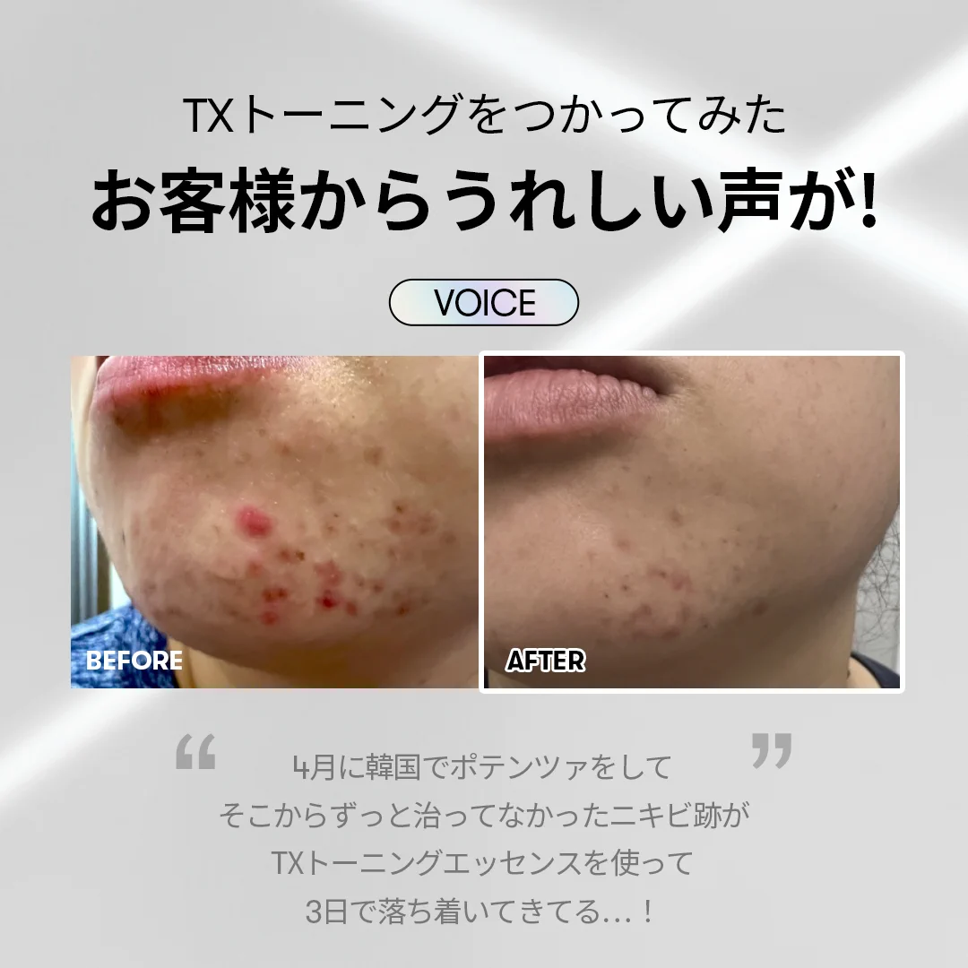 トラネキサム 酸 ニキビ