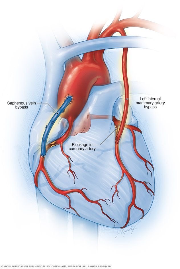 What a cabg coronary artery bypass looks like