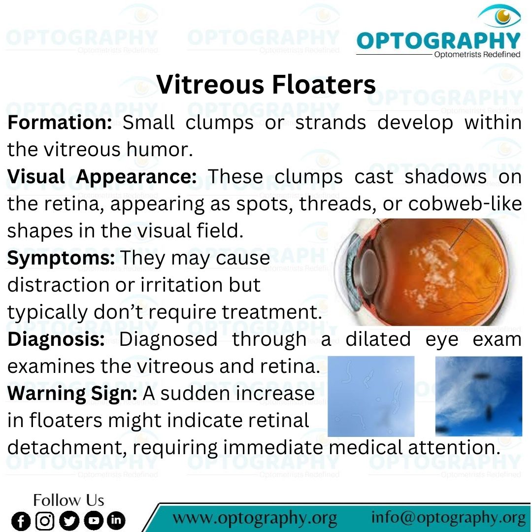 Optography8's tweet photo. Vitreous Floaters: While often harmless, these small clumps in the eye's vitreous humor can be a sign of something more serious. Regular eye exams are essential for early detection and peace of mind.
#VitreousFloaters #EyeHealth #Optometry #Optography #VisionCare #RetinalHealth https://t.co/8T8Zni1ouP