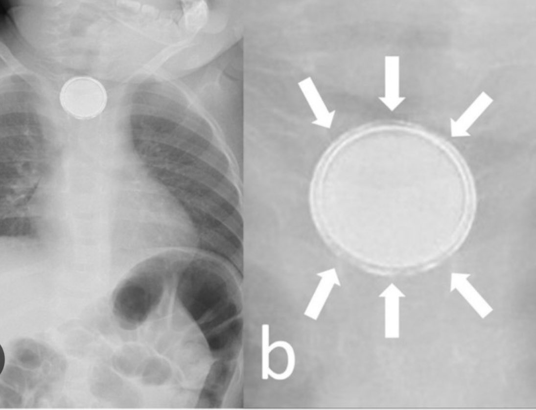 DrHeji_AlZoayed's tweet photo. رسالة إكلينيكية مهمة لأطباء الأطباء و مقدمي الرعاية الصحية للأطفال 

How to differentiate ingested button battery from a coin?

Disk batteries can cause significant serious injury when aspirated or swallowed.  Most ingestions occur in small children.  

They resemble coins. It is extremely important to differentiate them from coins.

Disc batteries can often be mistaken for coins, so care should be taken to make an accurate diagnosis.  

Evaluation of suspected button battery ingestion should include plain radiographs with both anteroposterior and lateral views of the head, neck, chest, and abdomen. 

Button batteries have a distinctive appearance with a step-off seen in the lateral view and a "double-density" or halo sign noted on the A-P view.