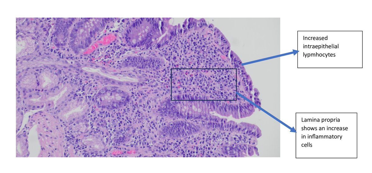 🚨 A 54-year-old woman on #Olmesartan for hypertension developed unexplained GI symptoms. Celiac serology was negative. It turned out to be Olmesartan-induced enteropathy.🩺 #PathTwitter #MedTwitter