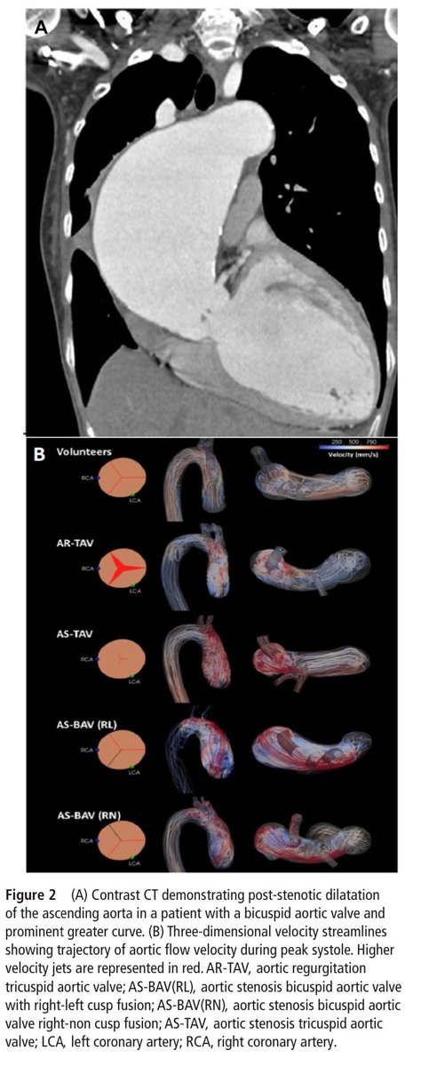 🔴 Management of bicuspid aortic valve disease in the transcatheter aortic valve implantation era <a href="/Heart_BMJ/">Heart_BMJ</a> #CardioEd #Cardiology #CardioTwitter