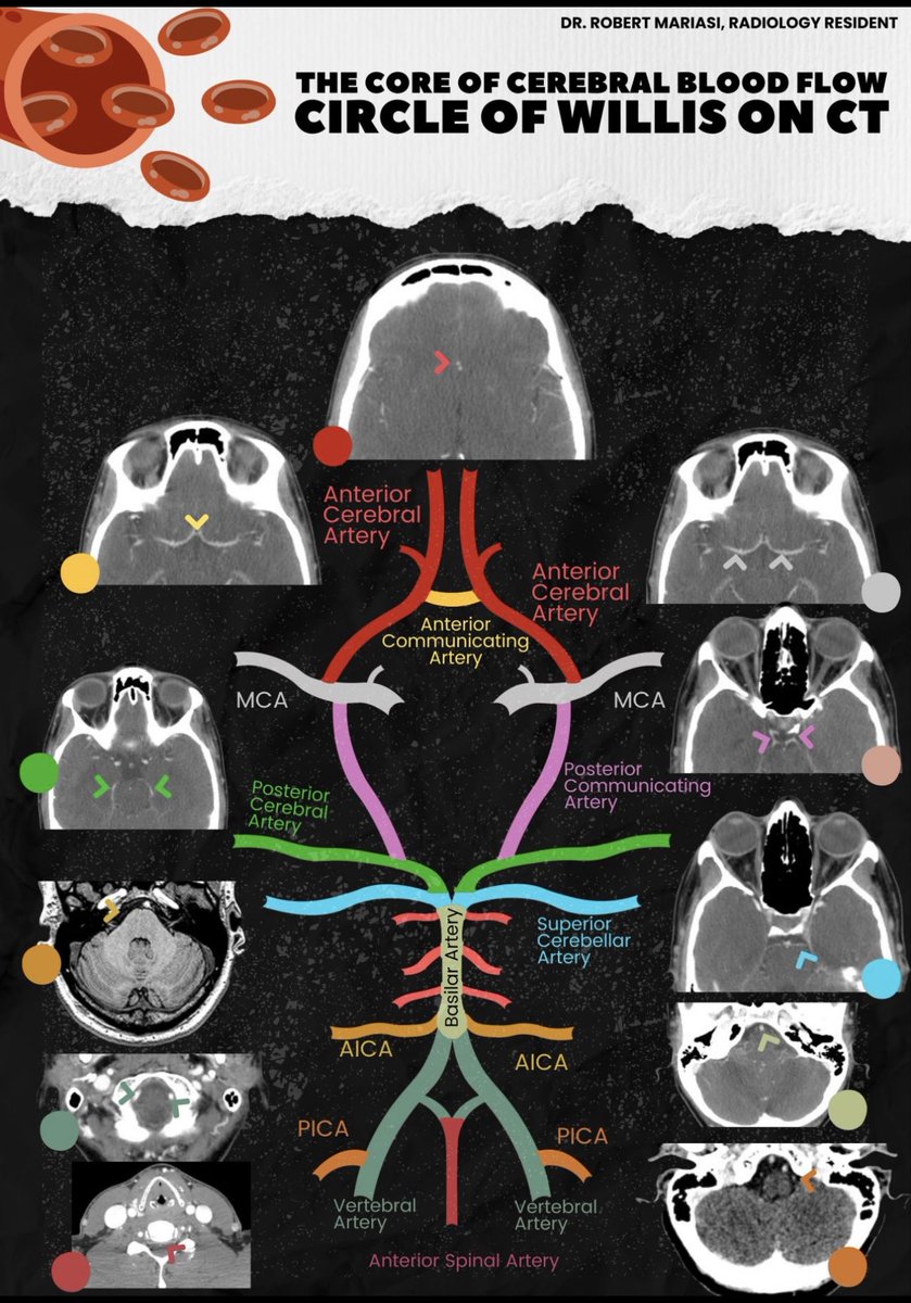 OGdukeneurosurg's tweet image. Circle of Willis on CT 
by Mariasi