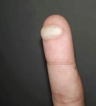 wikipistacho's tweet photo. me ha salido una ampolla en el dedo https://t.co/KjmnpNlgez