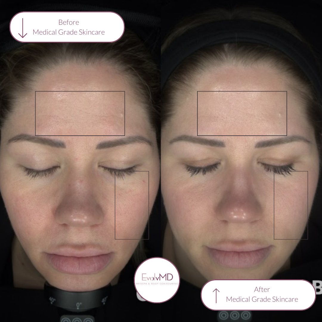 EvolvMD's tweet photo. On Mondays, we wear medical-grade skincare.:)  Before &amp; after.  The skin is brighter and the redness, inflammation, and texture have improved. Head to our stories to learn about OTC vs. medical-grade skincare. https://t.co/VHhoIbIM4q #skincare #skincaretips #antiaging #sunscreen https://t.co/g4UCTGTwBn