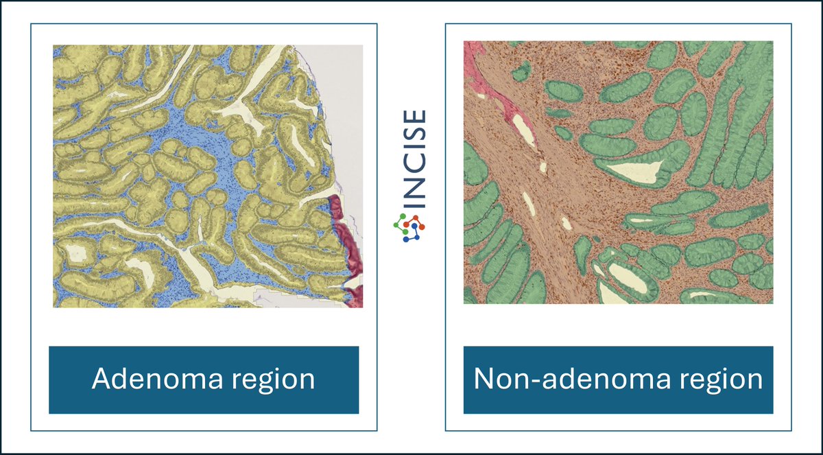 It has been a successful partnership with <a href="/OracleBio/">OracleBio</a> to bring cutting-edge image analysis to our immunohistochemistry-stained tissues <a href="/INCISE_research/">INCISE</a> #innovation #bowelcancer