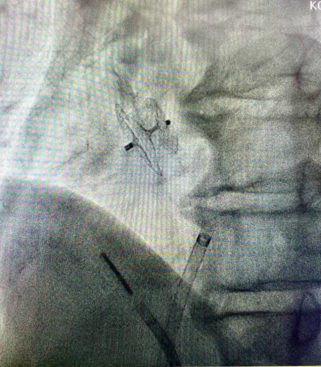 markzroland's tweet photo. Sometimes it takes a long time, sometimes with a little luck, we can get through very quickly 😇#CardioTwitter #Cardiology #patentforamenovale #structuralintervention https://t.co/VVPBO9y1Tt