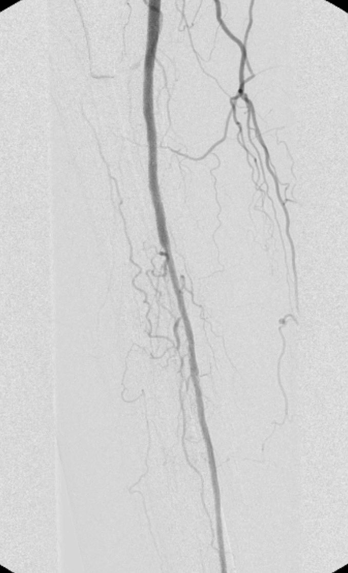 Nothing quite like a pop-tibial trifurcation CTO with single vessel peroneal run off and an obscuring prosthesis in a Ruth5 #CLI patient <a href="/SIRspecialists/">Society of Interventional Radiology</a> <a href="/SIR_ECS/">SIR ECS</a> <a href="/SIRRFS/">SIR RFS</a> <a href="/_MCLIN_/">Multidisciplinary CLI Network - CLI Global Society</a>