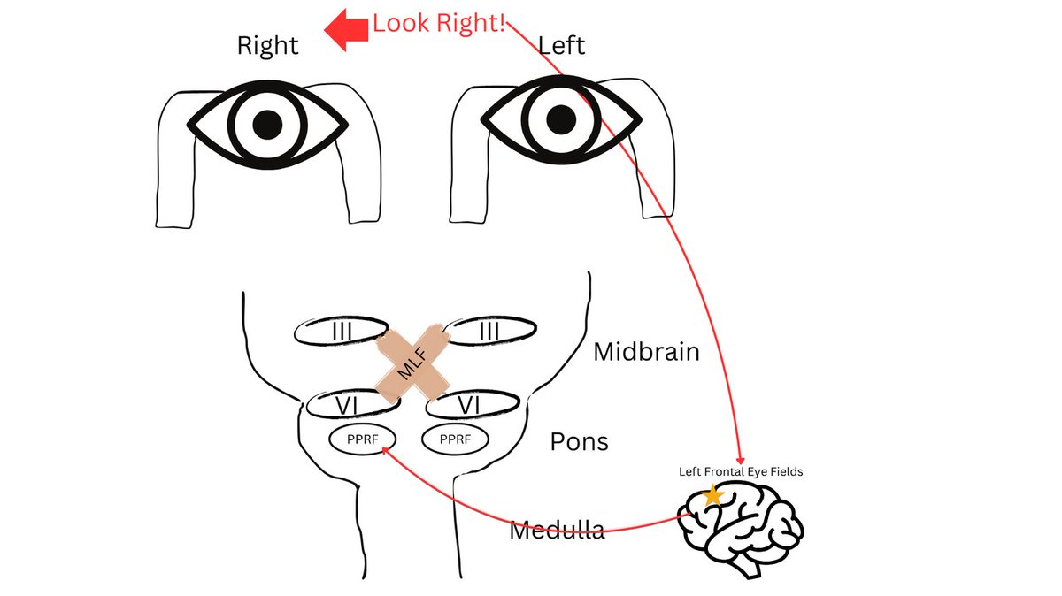 JohannaSeidenMD's tweet image. In order to understand pathology, we first have to understand physiology. Let's look at the pathway of coordinating our eyes to move together when we want to look in one direction. Here's what happens when we want to look to the right. #medstudenttwitter #meded #strokemed