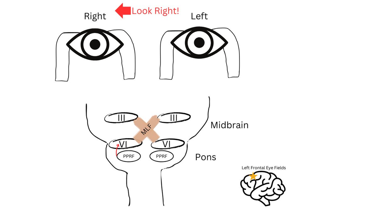 JohannaSeidenMD's tweet image. In order to understand pathology, we first have to understand physiology. Let's look at the pathway of coordinating our eyes to move together when we want to look in one direction. Here's what happens when we want to look to the right. #medstudenttwitter #meded #strokemed