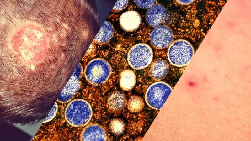 WebMD's tweet photo. The WHO has declared the mpox virus a global health emergency due to a worsening outbreak in the Democratic Republic of Congo and other parts of Africa. https://t.co/MM0epJmEZ4 https://t.co/2oecQ35gNj
