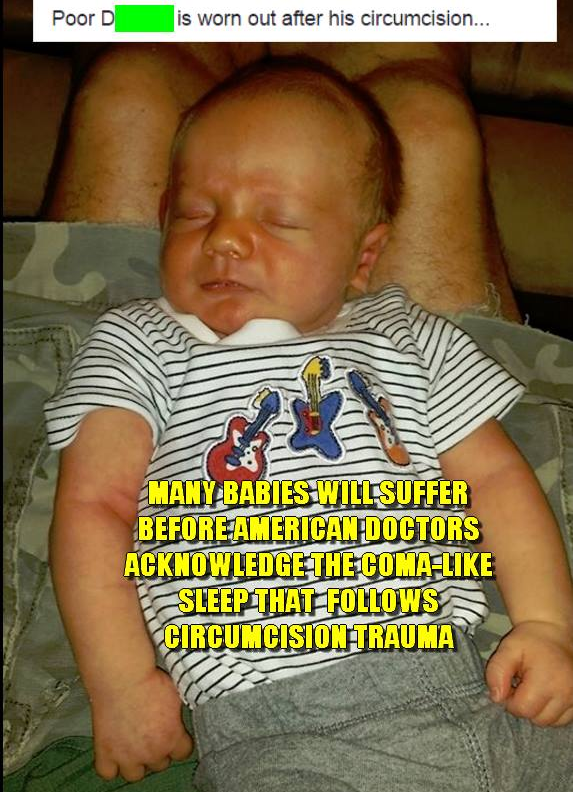 The universal unconsciousness that babies suffer after genital torture is NOT sleep, though doctors assure parents that the boy is asleep. HE IS NOT. This is a trauma-induced state of unconscious shock. In fact, the child's developing brain never returns to its pre-trauma state.