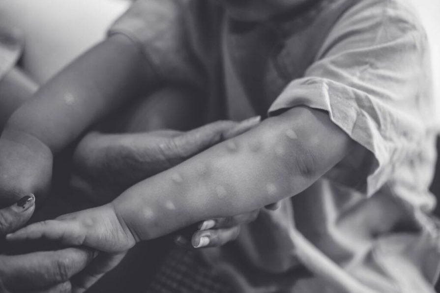 BazzukuluDocs's tweet photo. @WHO EXD  @DrTedros has determined that the upsurge of #Mpox in the Democratic Republic of the Congo (DRC) and a growing number of countries in Africa, constitutes a public health emergency of international concern (PHEIC) under the International Health Regulations (2005) (IHR). https://t.co/TvdyGWjpjS