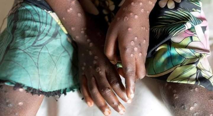 Andu matanyihirie 2863 nio manyitikanite na murimu wa Monkey Pox na angi 517 gukua riri 
mabururi 13 gitaroini kia Afrika ni igomeirwo ni murimu uyu. 
#kihootonews