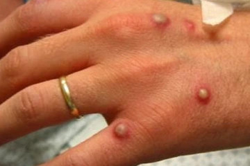 🔴🔴 #maymunçiceği (MPOX) (MPXV)

⭐️DSÖ Acil durum ilan etti ki zaten bekleniyordu. Çünkü Afrika CDC ilan etmisti.

⭐️Detaylı şekilde hastalığı,,mekanizmasini, yapılabilecekleri yazacam ama en başta şunu yazayım. 

▶️Şu an için Covid19 gibi bir kapanma, pandemi süreci OLUŞMAZ..