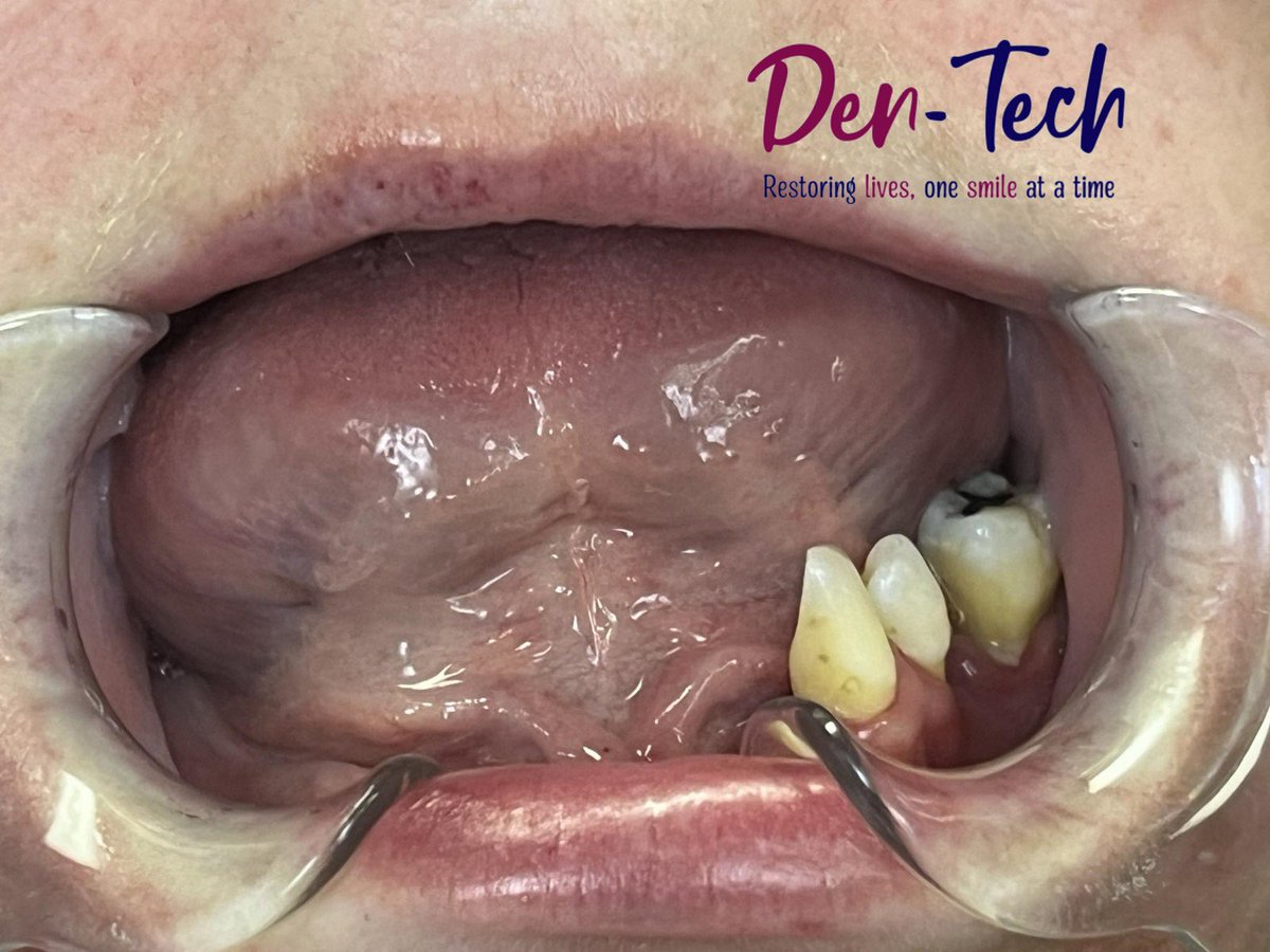 This brave lady has endured unimaginable hardships, suffering significant damage and tooth loss due to domestic abuse. 
We are endlessly grateful to all who make this possible. Together, we’re not just restoring smiles—we’re changing lives. 🙏

Thank you to Donna Cole CDT 💙