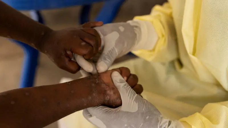 duyumzirvesi's tweet photo. Yeni virüs riski: 13 Ülkeye yayıldı.
M çiçeği (mpox) virüsü hızla yayılıyor. Afrika Birliği, Afrika' da yayılan virüse karşı kıta çapında halk sağlığı için acil durum ilan edildiğini bildirdi. 13 ülkede görülen virüsten sebep 517 kişi yaşamını yitirdi. #DaiShun #ShunDai #Kursk https://t.co/o5lU6Mr3l3
