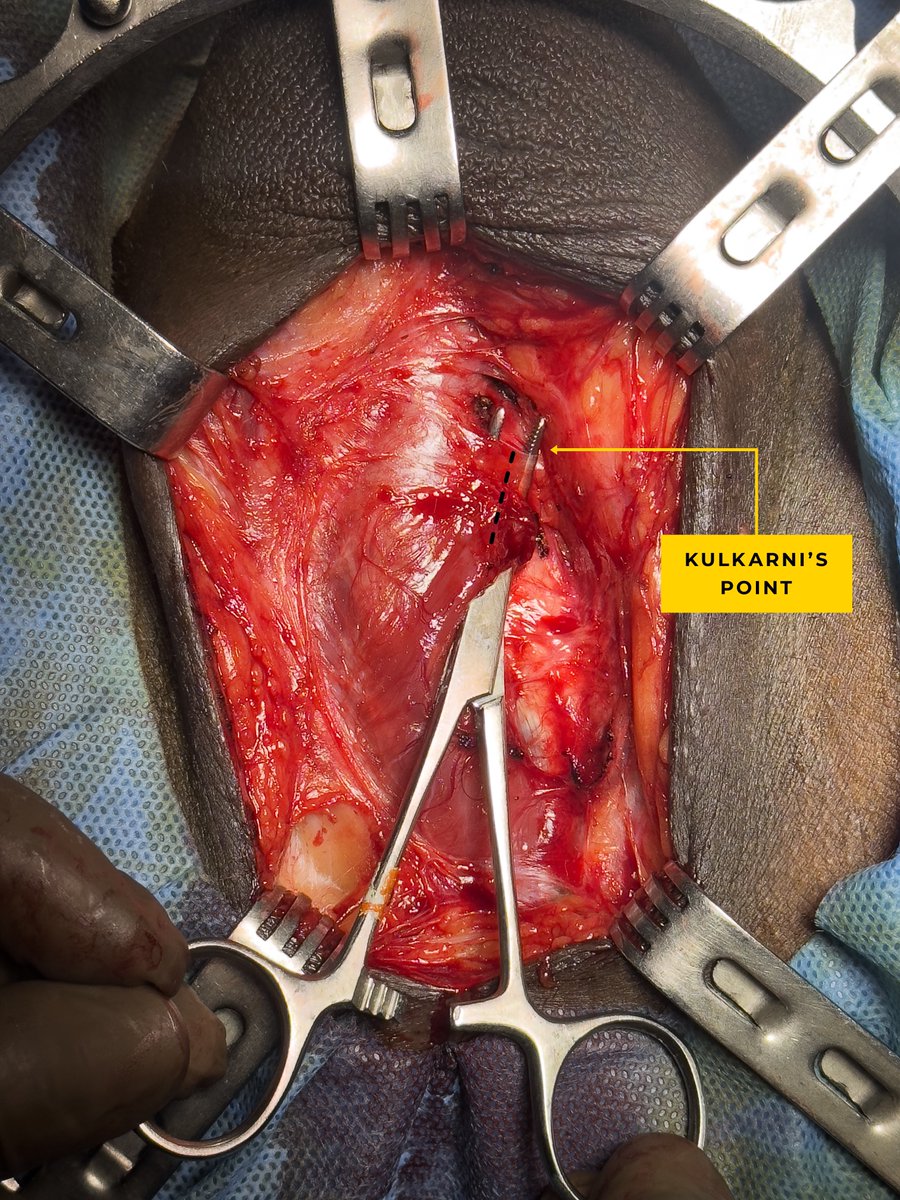 chica de uro✨ (@lachicadeuro) on Twitter photo ✅The Kulkarni's Point is the exact lateral place for the incision of the bulbospongiosus muscle to perform a one-sided dissection of the urethra for dorsal onlay BMG urethroplasty.
📍UROKUL <a href="/drjoshi_pankaj/">Pankaj M Joshi</a> <a href="/sanjaybkulkarni/">Dr Sanjay Kulkarni</a> <a href="/meritxellcostag/">Meritxell Costa</a> #UroSoMe #DorsalOnlay #KeyPoints ✅The Kulkarni's Point is the exact lateral place for the incision of the bulbospongiosus muscle to perform a one-sided dissection of the urethra for dorsal onlay BMG urethroplasty.
📍UROKUL <a href="/drjoshi_pankaj/">Pankaj M Joshi</a> <a href="/sanjaybkulkarni/">Dr Sanjay Kulkarni</a> <a href="/meritxellcostag/">Meritxell Costa</a> #UroSoMe #DorsalOnlay #KeyPoints