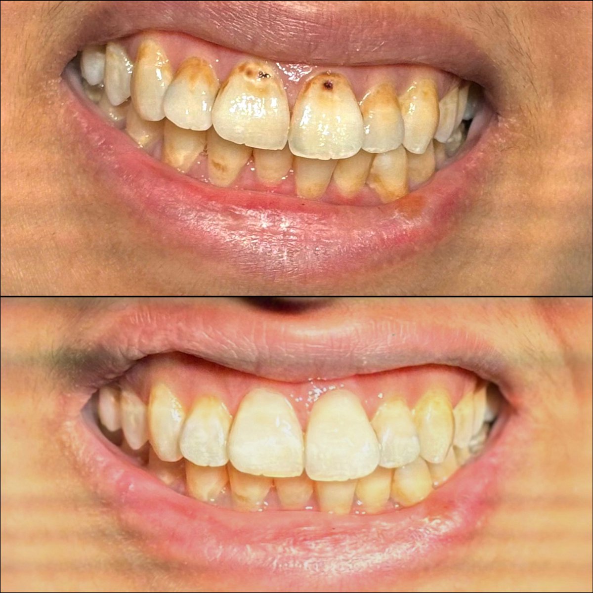dalia_mr77's tweet photo. Today’s case

- completing a full mouth scaling
-restoration of Class V lesions on the upper central incisors (#11, 21)
-Class III restoration on tooth #21. 

The main challenge was to completing the treatment within a 40-minute timeframe and it’s Done ✔️✔️ https://t.co/IISrYtHKKm