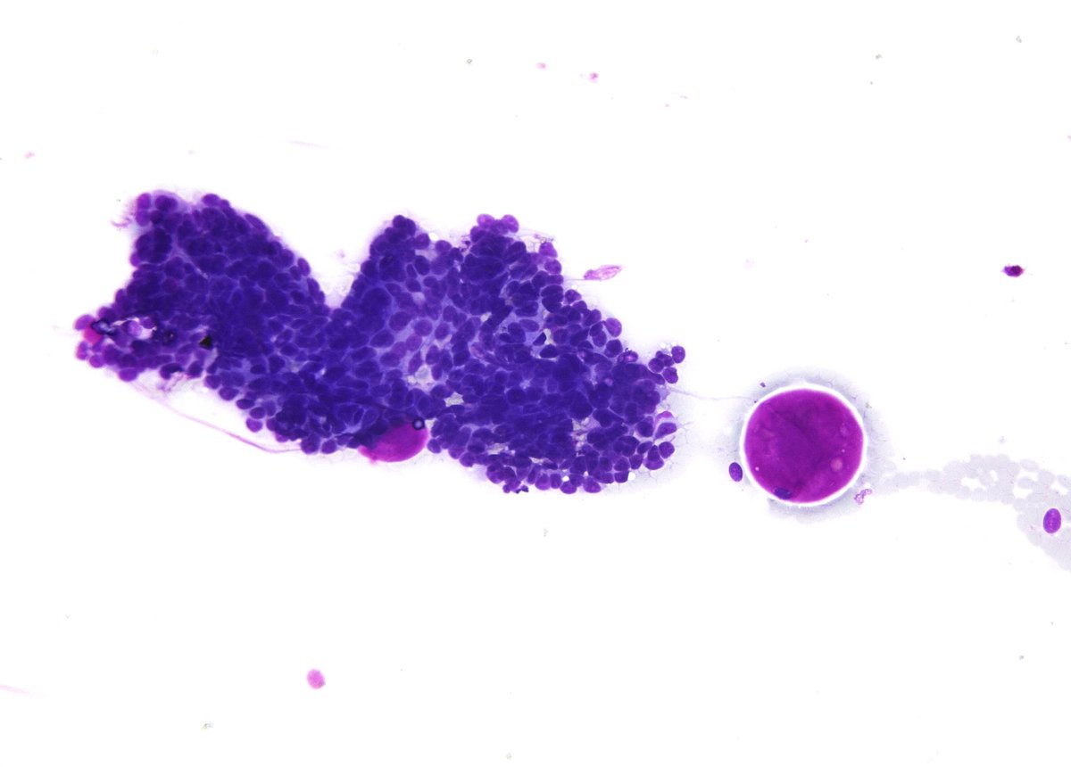Syed Z. Ali (@sza_jhcyto) on Twitter photo “Architectural Diversity” is frequently touted as a hallmark feature of salivary gland “Polymorphous Adenocarcinoma” (PAC). Here is an example of a PAC on FNA of an intraoral mass simulating an adenoid cystic carcinoma. <a href="/DianaEstherossi/">Esther Diana Rossi</a> “Architectural Diversity” is frequently touted as a hallmark feature of salivary gland “Polymorphous Adenocarcinoma” (PAC). Here is an example of a PAC on FNA of an intraoral mass simulating an adenoid cystic carcinoma. <a href="/DianaEstherossi/">Esther Diana Rossi</a>