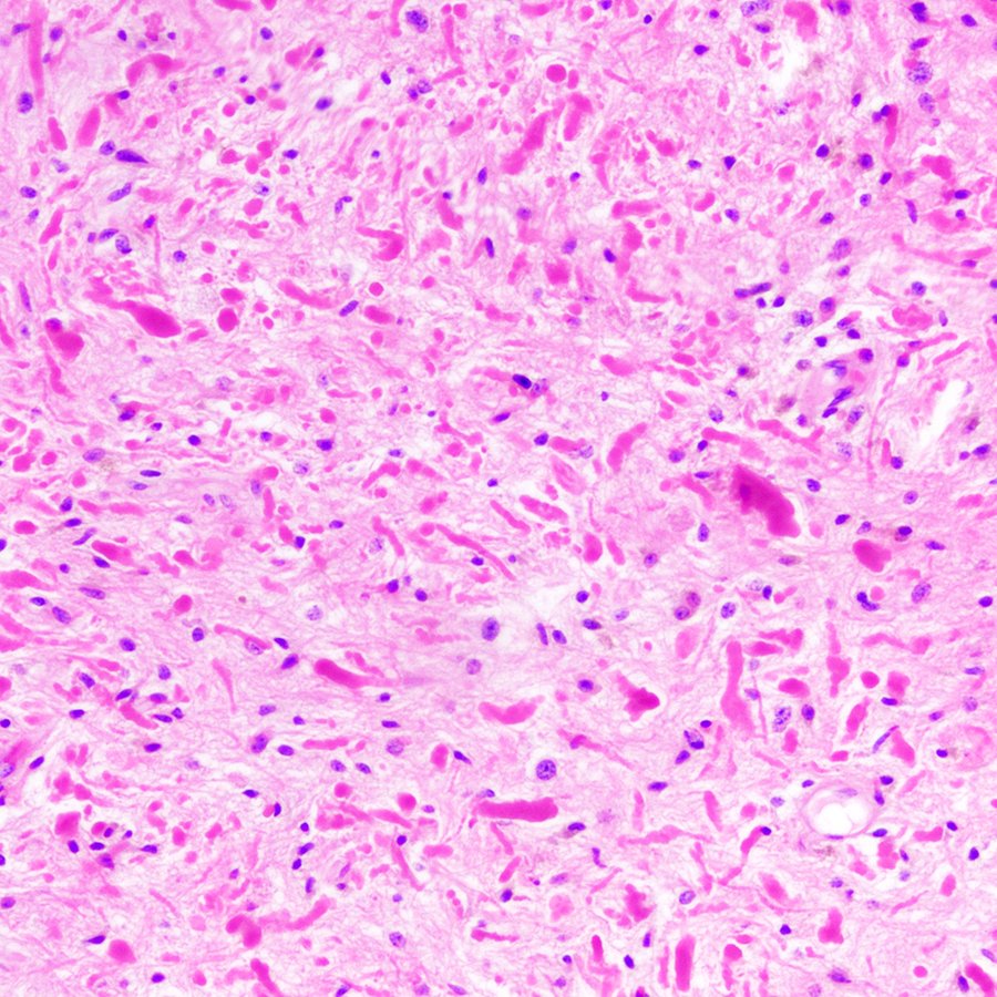 When looking at a pilocytic astrocytoma, it's always good to stop and smell the ROSEnthal fibres. #pathology #neuropath #pathtwitter