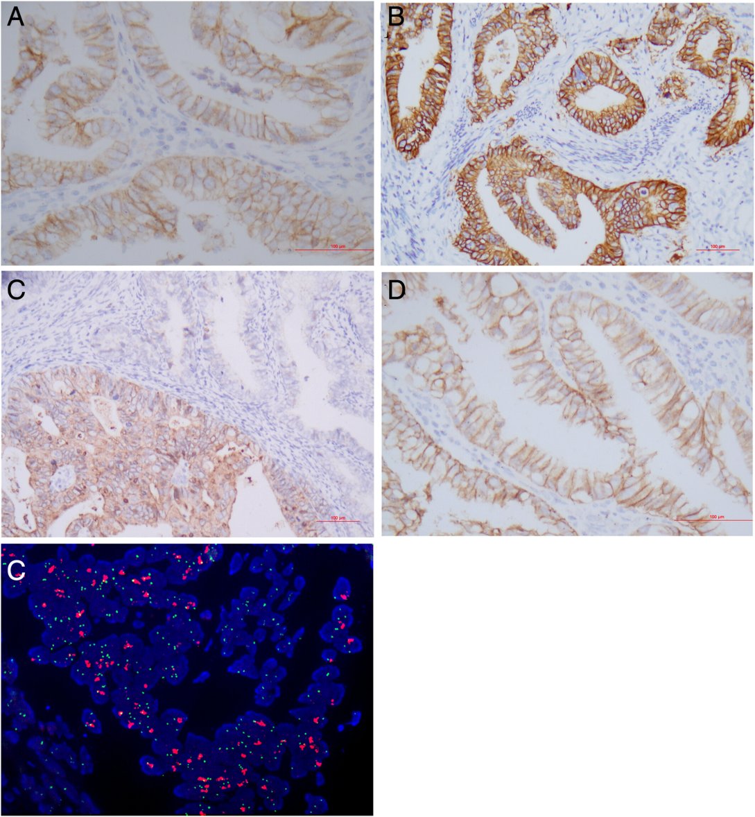 Swikrity U Baskota,MD, FCAP (@baskotacytopath) on Twitter photo A6: Some examples of HER2 expression and amplification in cervical adenocarcinoma.
#HER2, #PathTwitter, #GynPath, and #pathx <a href="/ASCP_Chicago/">ASCP</a> <a href="/AnneMillsMD/">Anne Mills</a> <a href="/DrBuiPathology/">Dr. Bui Pathologist🌼</a> A6: Some examples of HER2 expression and amplification in cervical adenocarcinoma.
#HER2, #PathTwitter, #GynPath, and #pathx <a href="/ASCP_Chicago/">ASCP</a> <a href="/AnneMillsMD/">Anne Mills</a> <a href="/DrBuiPathology/">Dr. Bui Pathologist🌼</a>