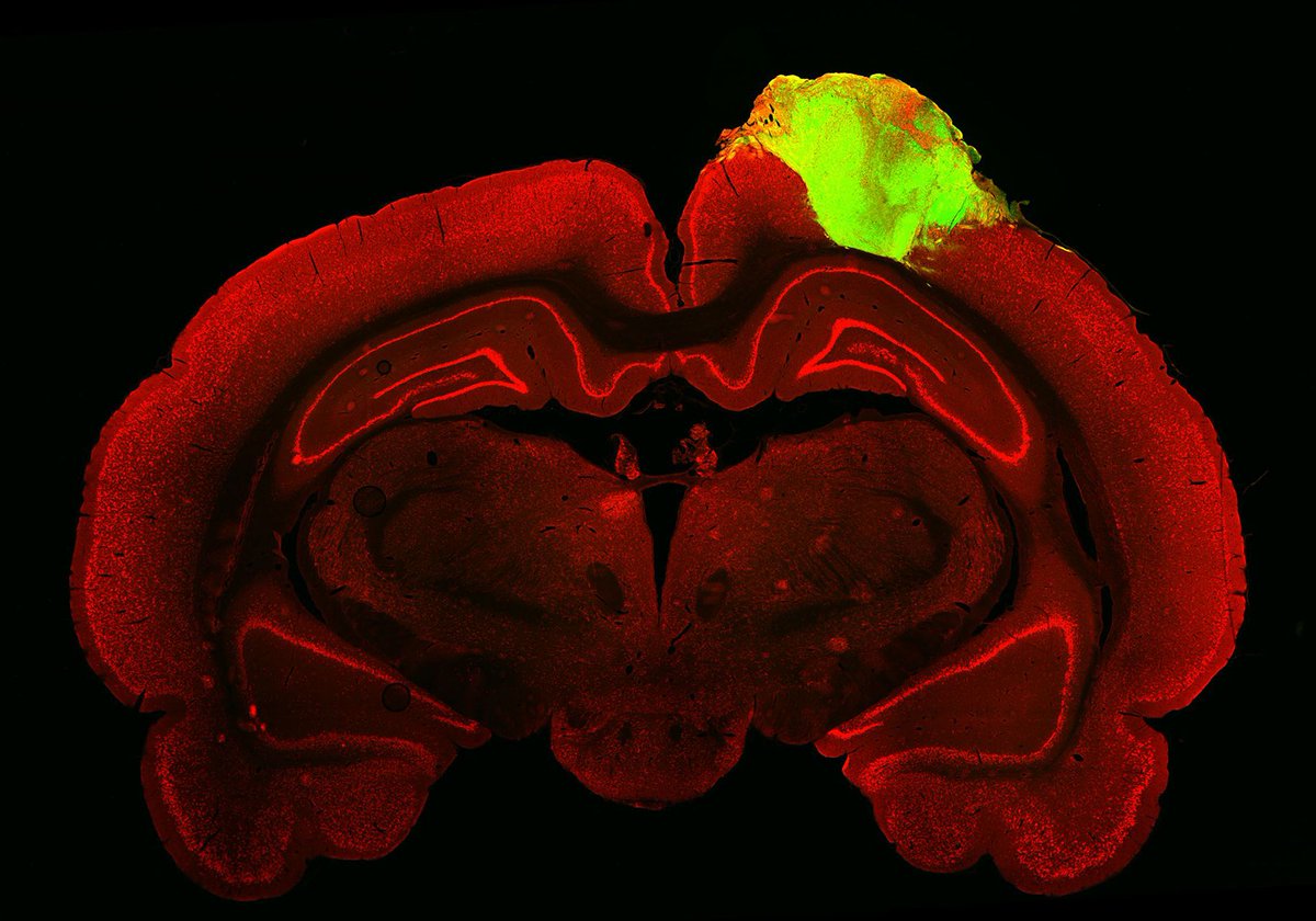 DanLewisFndtn's tweet photo. Brain Regeneration via Brain Tissue Transplantation: With recent breakthroughs, scientists are now able to transform readily available blood or skin cells into pluripotent stem cells (iPSCs) and reprogram them into neurons. Read more: https://t.co/LUGHOJXf61 https://t.co/rJ05cOH6KT
