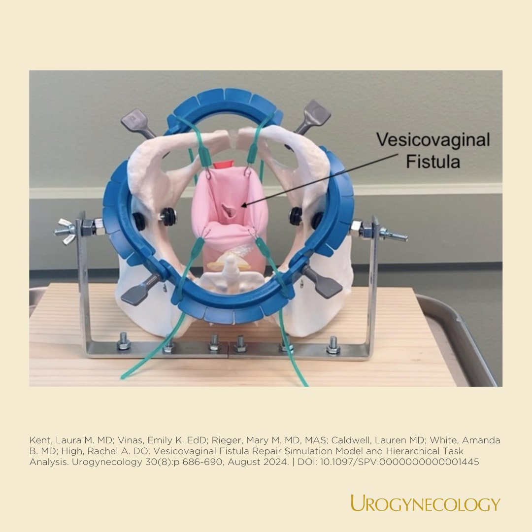 These authors created a clever low-fidelity transvaginal vesicovaginal fistulae (VVF) simulation model that addresses a current gap in surgical training and replicates procedural tasks including identification and closure of VVF.

journals.lww.com/fpmrs/fulltext…