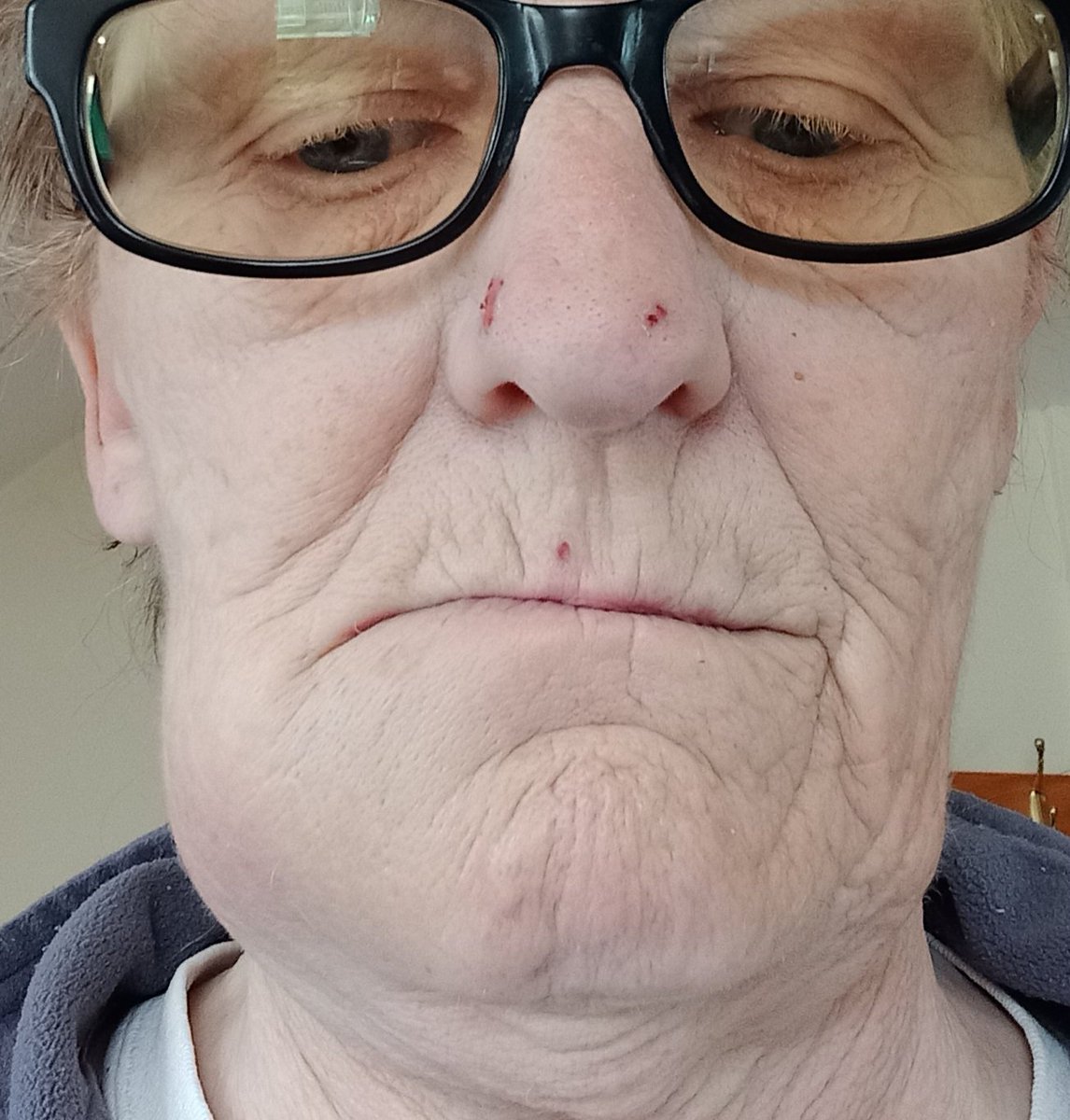 WatkinsWanders's tweet photo. Just a tad swollen. What I wouldn't  give to find an NHS dentist. @weewelshwitch @NHSWales #nodentists #notreatment #pensioners https://t.co/8tiTSNL3Ap