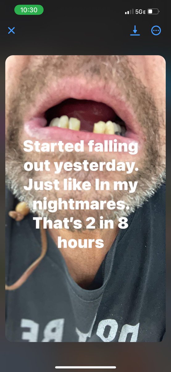 ASS_pen17's tweet photo. @pulte My dad struggled with drug addiction in the past and is sober now but his teeth are paying the price unfortunately and makes my dad feel super self conscious https://t.co/3OImejBnJk