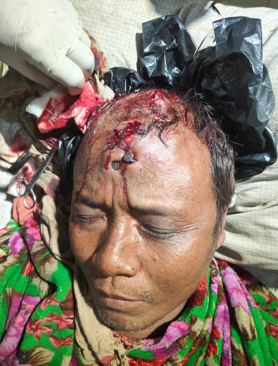 TheKanglei54850's tweet photo. #Kukis Brutality on a #Gangte Tribal

Today, in a scuffle over #Kukiland &amp; #Zoland issue, @Kuki_Inpi volunteers caught a #Gangte tribal volunteers of @ITLFMedia_Cell &amp; nailed him on his forehead.

The man with sever head injuries is taken to #Churachandpur hospital https://t.co/0m50g05H68